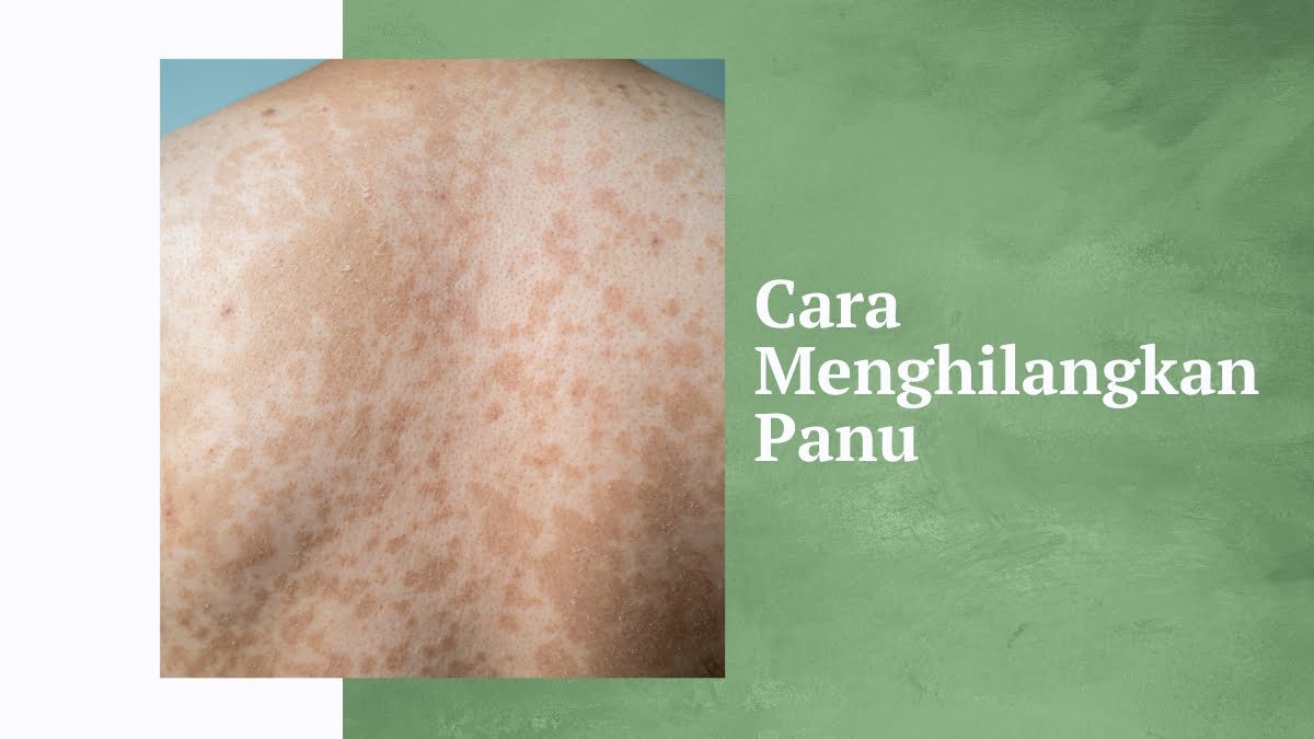 Cara menghilangkan panu