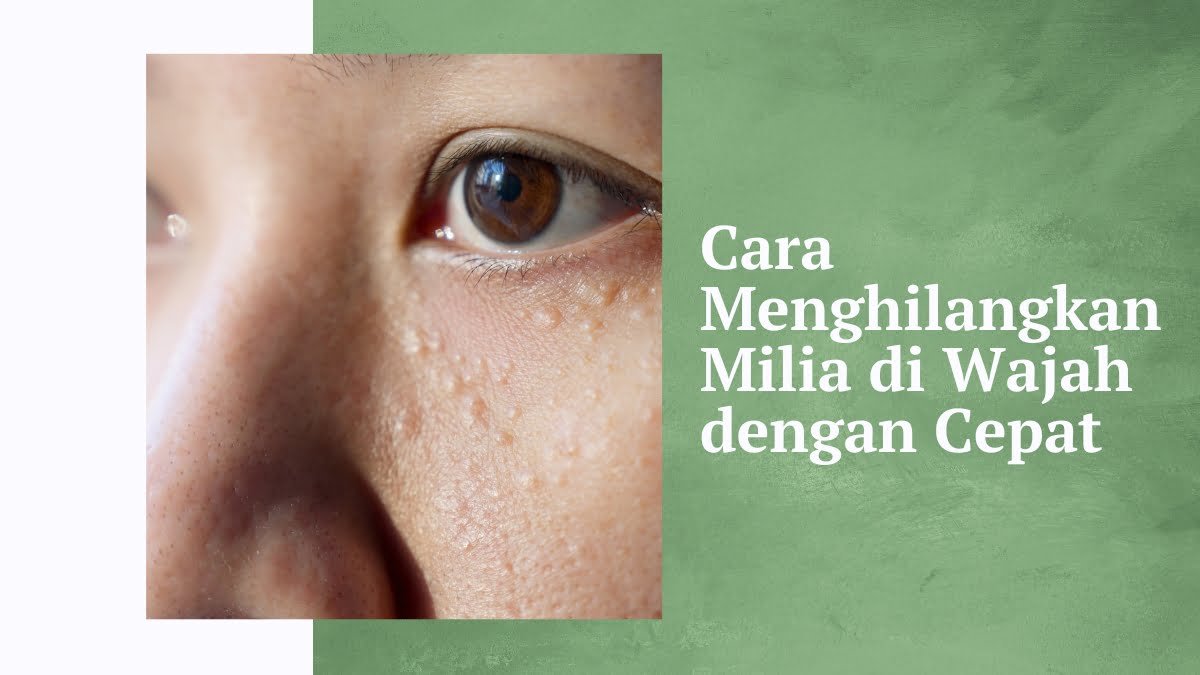 Cara menghilangkan milia di wajah dengan cepat